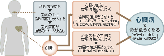 「歯周病」と「心臓病」の関係