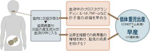 「歯周病」と「低体重児出産」の関係