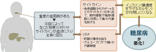 「歯周病」と「糖尿病」の関係