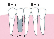 歯が中間で1本抜けた場合(インプラント)