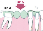 歯が中間で2本抜けた場合(ブリッジ)