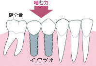歯が中間で2本抜けた場合(インプラント)