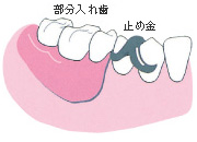 奥歯が数本抜けた場合(部分入れ歯)