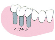 奥歯が数本抜けた場合(インプラント)