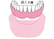 歯が全部抜けた場合(総入れ歯)