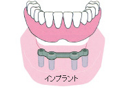 歯が全部抜けた場合(インプラント)