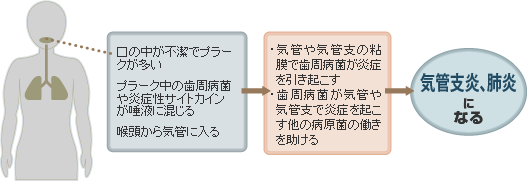 「歯周病」と「肺炎」の関係
